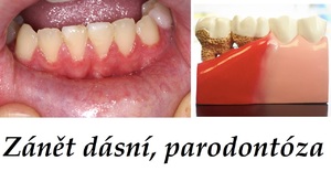 dasne zanet dasni parodontoza byliny bylinky babske rady ustni voda zubni olej